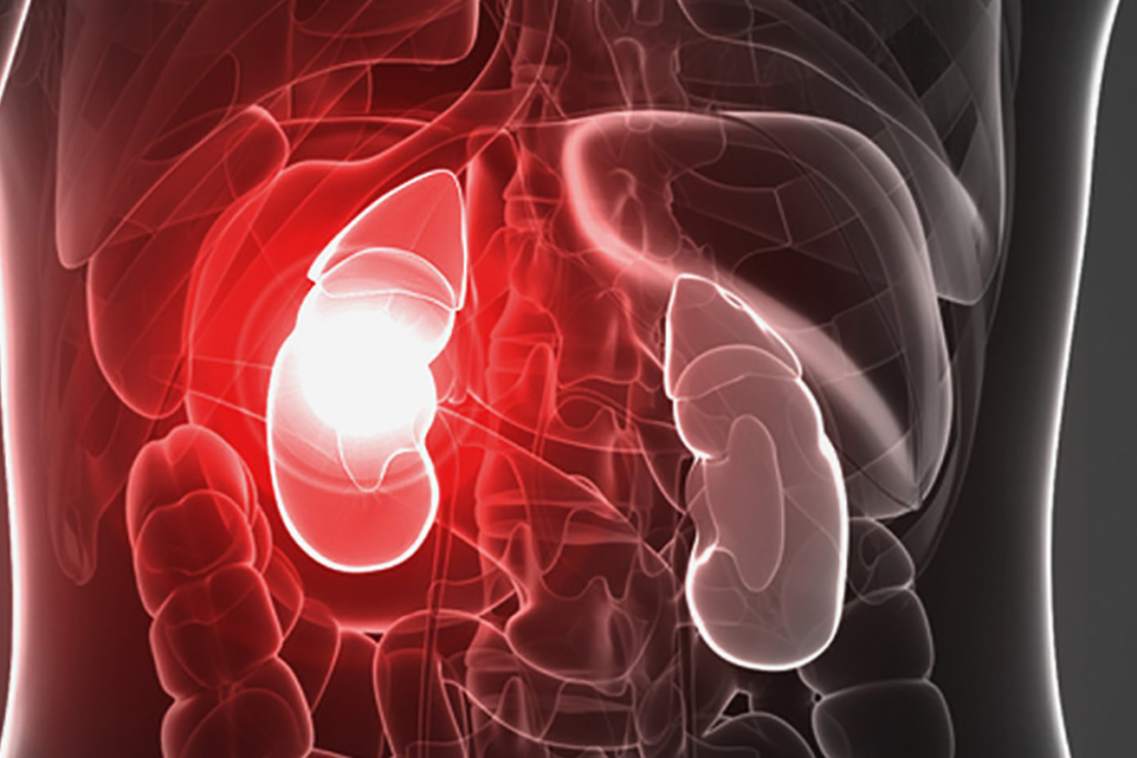 Kidney Damage (Nephropathy)